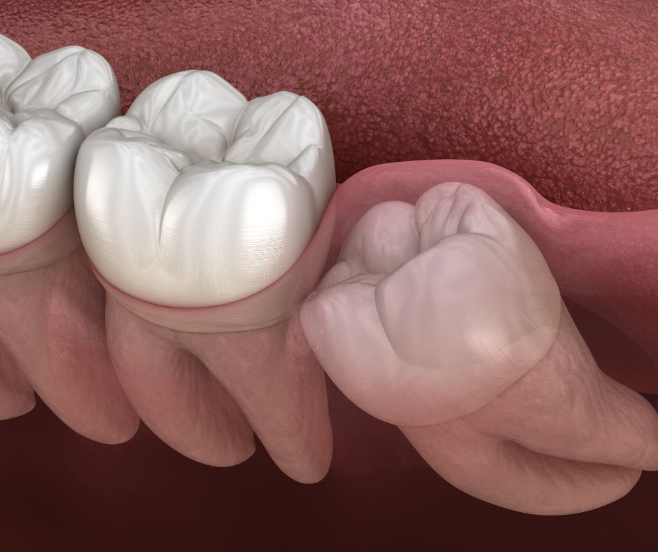 Ilustração de um dente siso incluso, inclinado sob a gengiva e encostado no dente vizinho