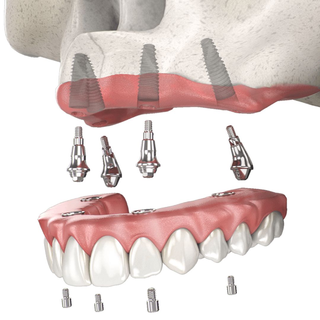 Ilustração de protocolo: prótese fixa da arcada superior inteira, parafusada sobre quatro implantes